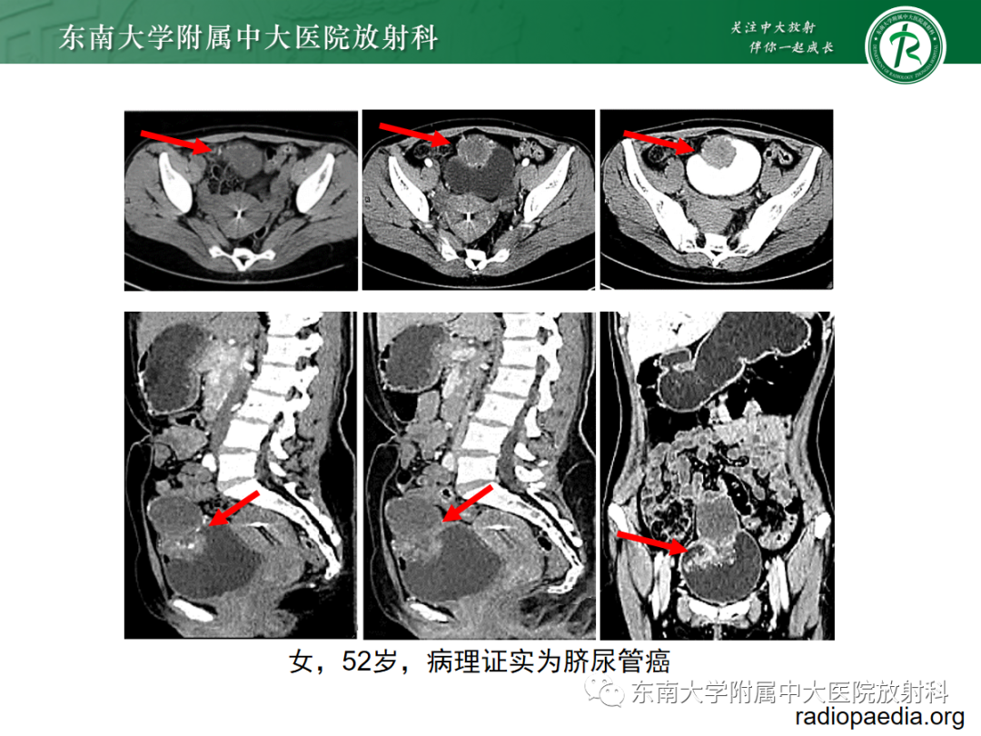 影像PPT - 【PPT】脐尿管病变-18
