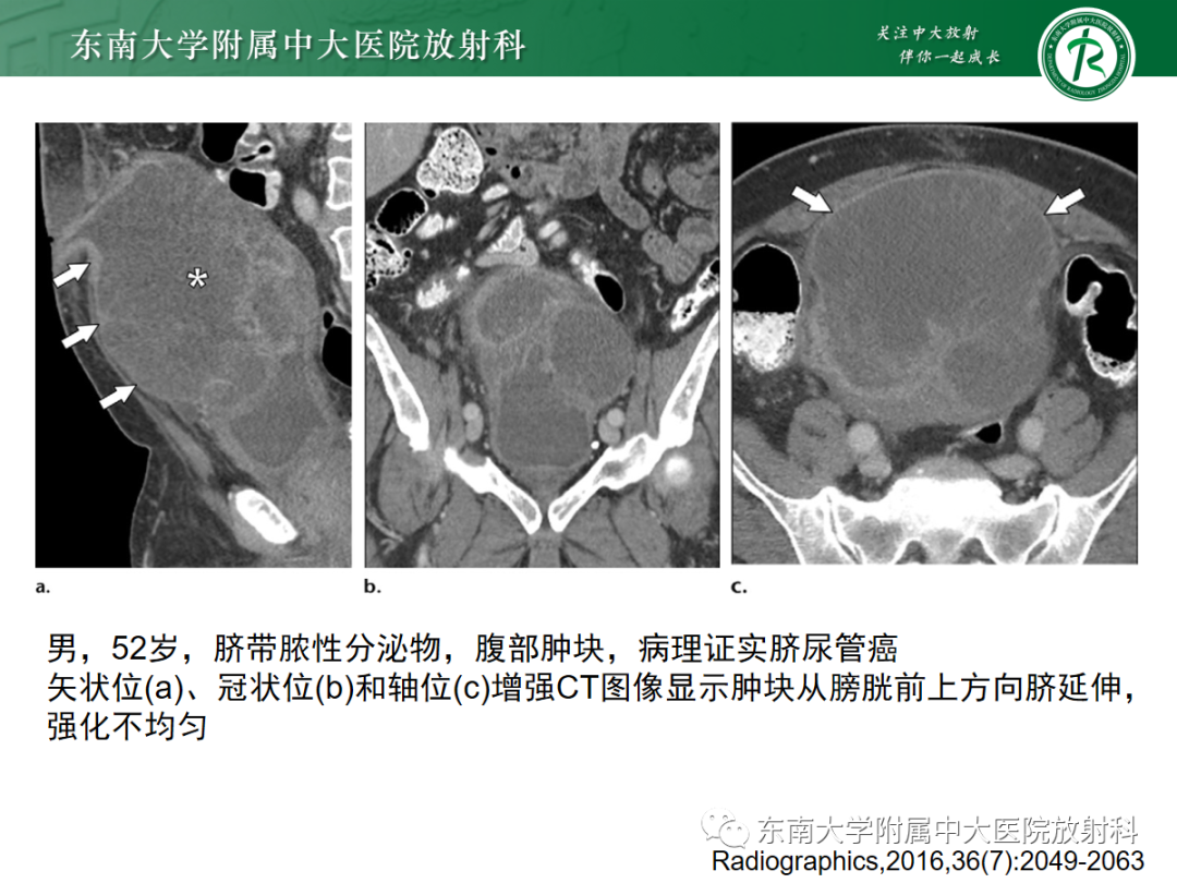 影像PPT - 【PPT】脐尿管病变-19
