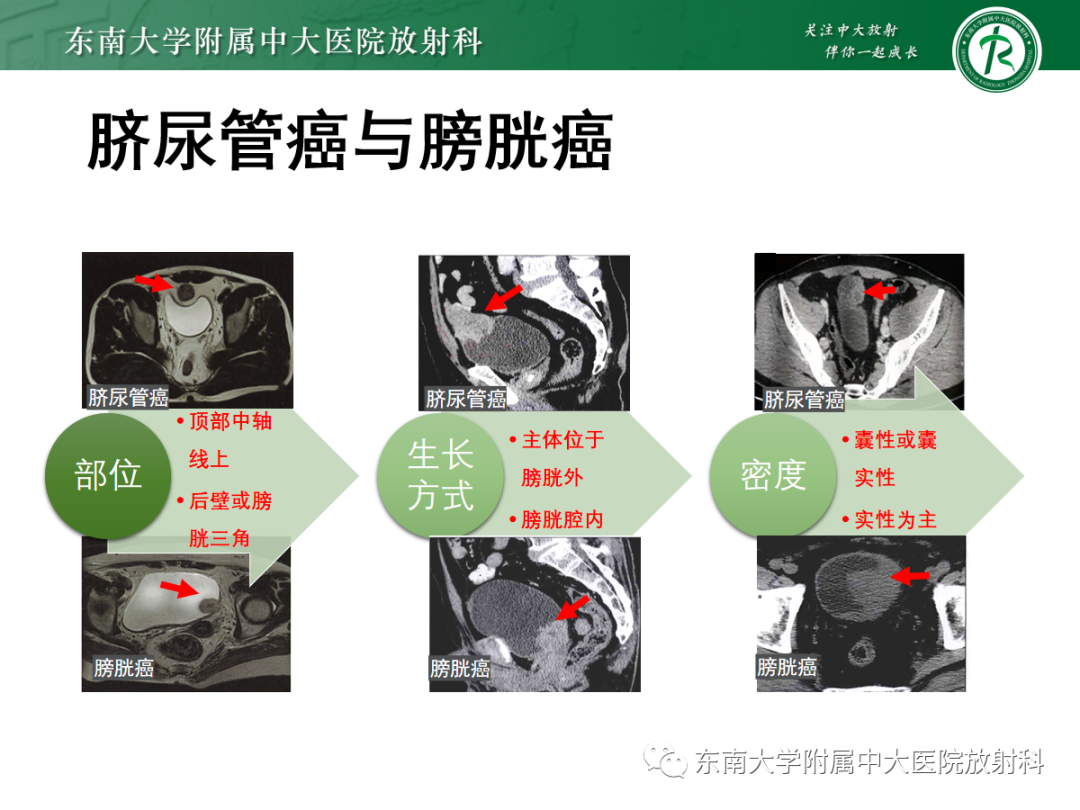 影像PPT - 【PPT】脐尿管病变-25