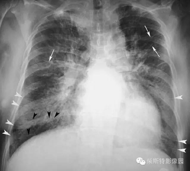 影像PPT - 影像经典之KerleyA线、KerleyB线、KerleyC线-1 影像PPT - 影像经典之KerleyA线、KerleyB线、KerleyC线-1