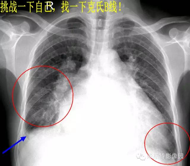 影像PPT - 影像经典之KerleyA线、KerleyB线、KerleyC线-3 影像PPT - 影像经典之KerleyA线、KerleyB线、KerleyC线-3