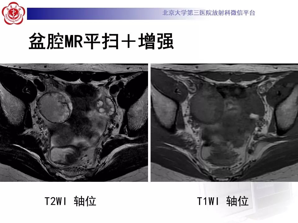 影像PPT - 【PPT】卵巢交界性肿瘤影像诊断-3