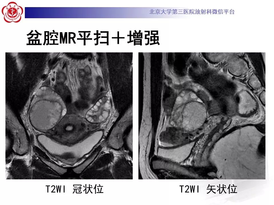 影像PPT - 【PPT】卵巢交界性肿瘤影像诊断-4