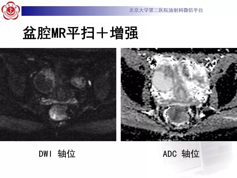 影像PPT - 【PPT】卵巢交界性肿瘤影像诊断-5
