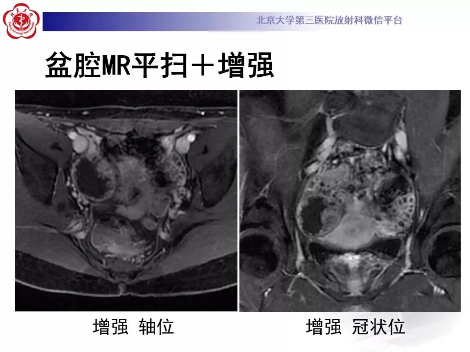 影像PPT - 【PPT】卵巢交界性肿瘤影像诊断-6