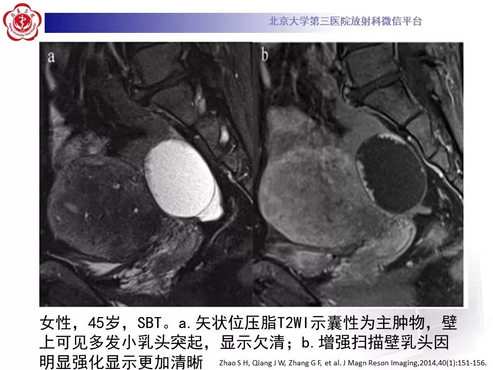 影像PPT - 【PPT】卵巢交界性肿瘤影像诊断-20