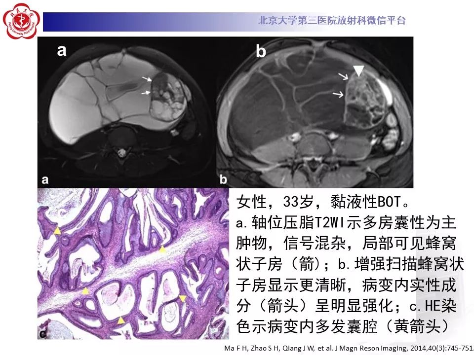 影像PPT - 【PPT】卵巢交界性肿瘤影像诊断-22