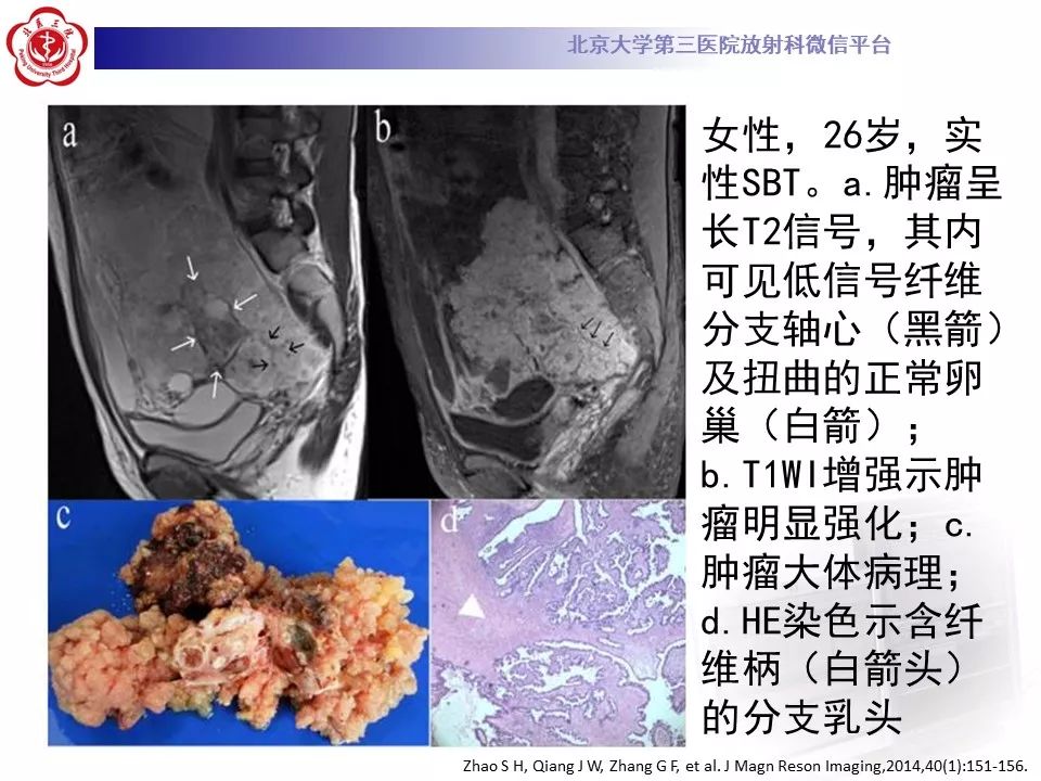 影像PPT - 【PPT】卵巢交界性肿瘤影像诊断-21