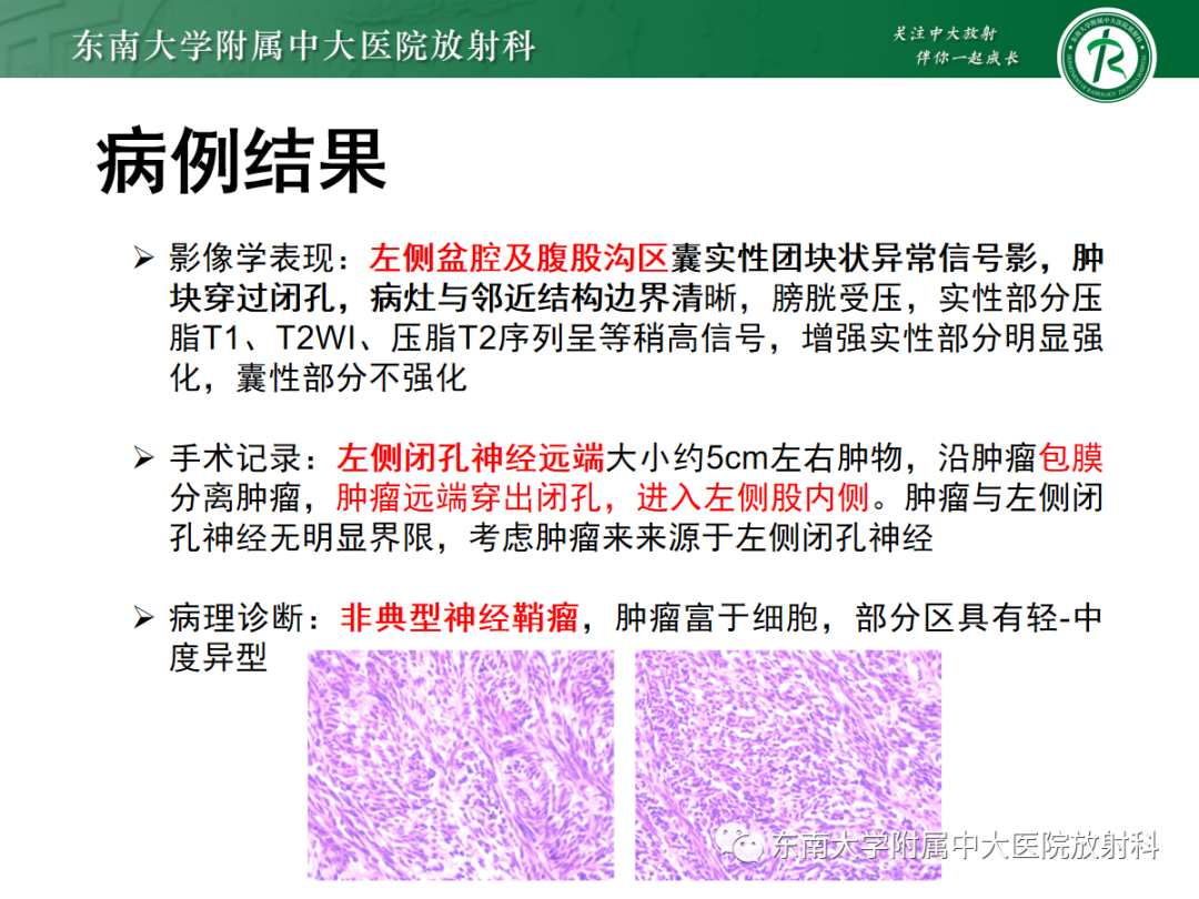 影像PPT - 【PPT】软组织内神经源性肿瘤—神经鞘瘤-2