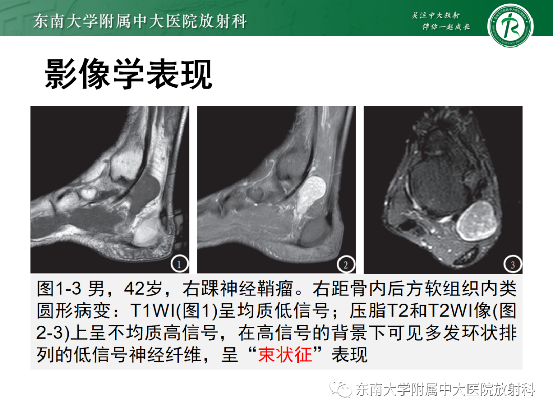 影像PPT - 【PPT】软组织内神经源性肿瘤—神经鞘瘤-10