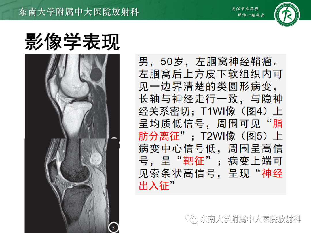 影像PPT - 【PPT】软组织内神经源性肿瘤—神经鞘瘤-11