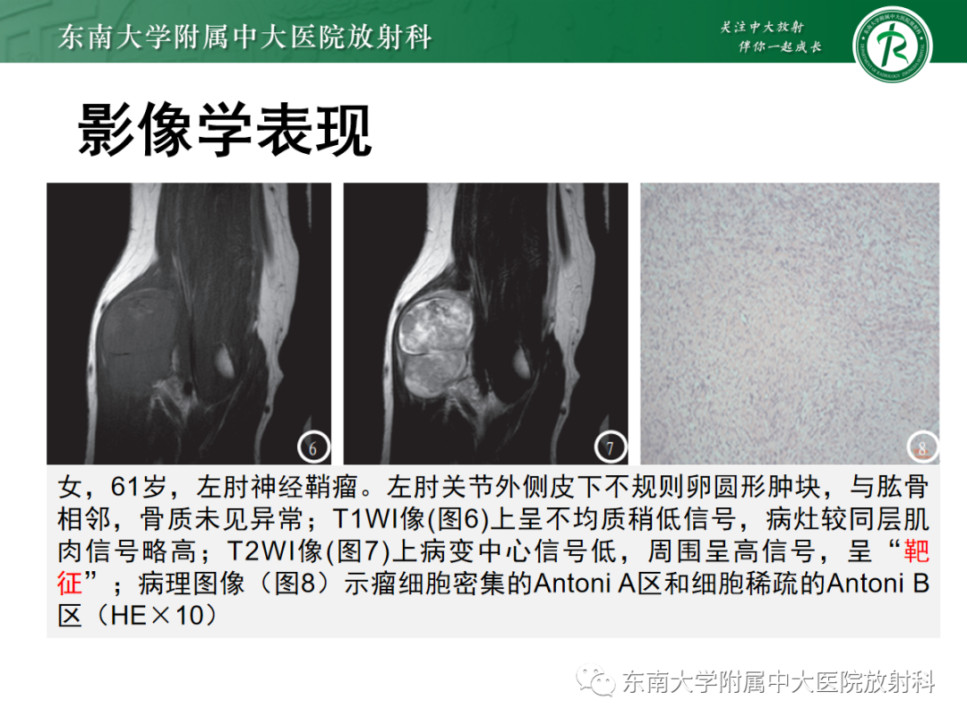 影像PPT - 【PPT】软组织内神经源性肿瘤—神经鞘瘤-12