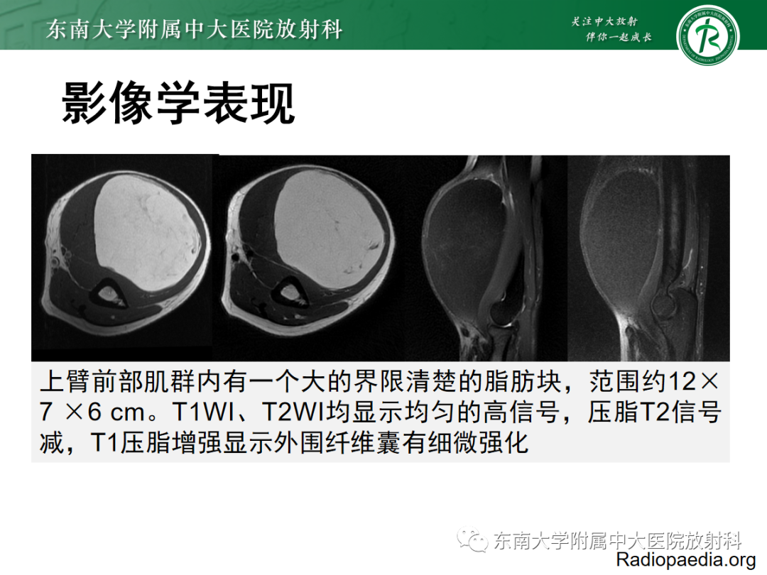 影像PPT - 【PPT】软组织内神经源性肿瘤—神经鞘瘤-16
