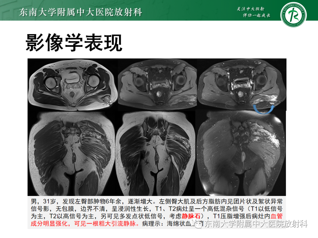 影像PPT - 【PPT】软组织内神经源性肿瘤—神经鞘瘤-20