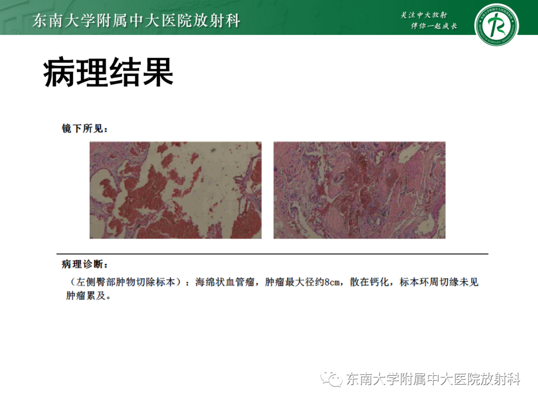 影像PPT - 【PPT】软组织内神经源性肿瘤—神经鞘瘤-21
