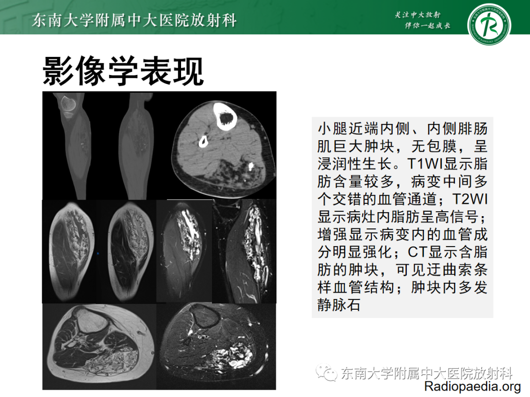 影像PPT - 【PPT】软组织内神经源性肿瘤—神经鞘瘤-22
