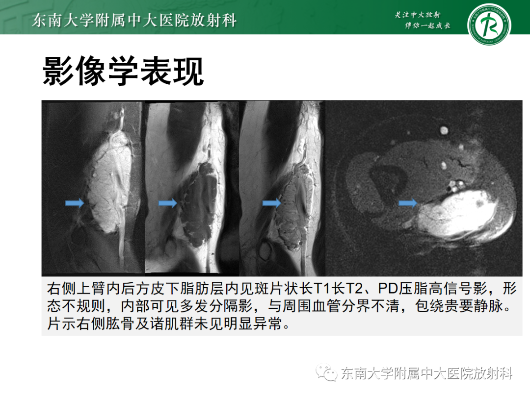 影像PPT - 【PPT】软组织内神经源性肿瘤—神经鞘瘤-25