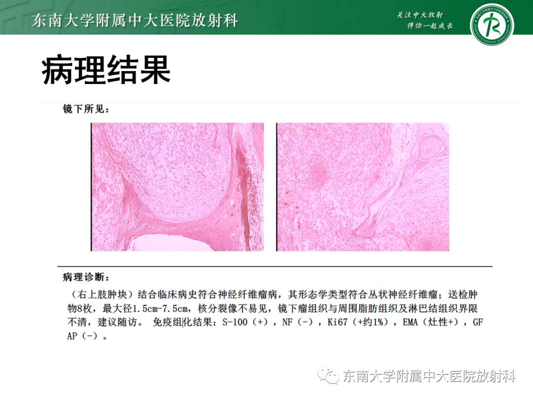 影像PPT - 【PPT】软组织内神经源性肿瘤—神经鞘瘤-26