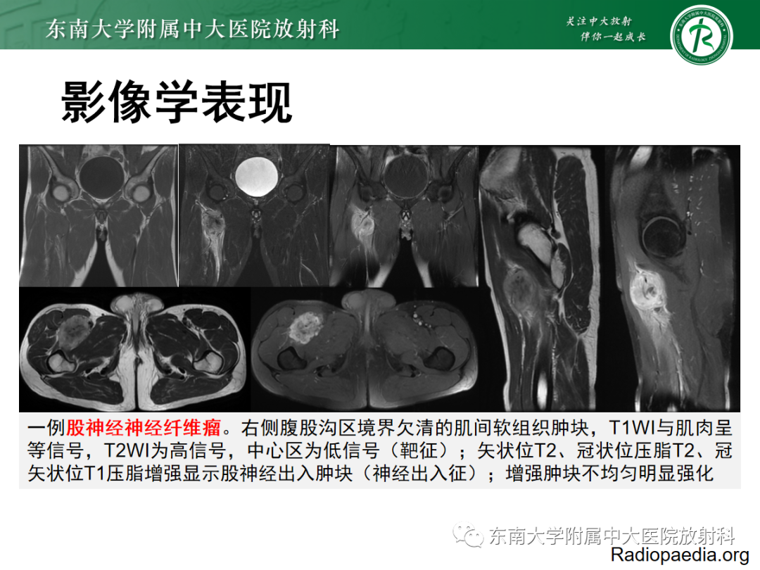 影像PPT - 【PPT】软组织内神经源性肿瘤—神经鞘瘤-27