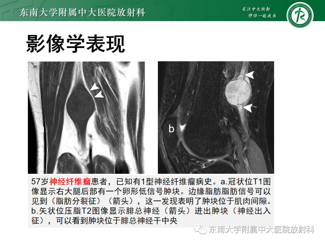 影像PPT - 【PPT】软组织内神经源性肿瘤—神经鞘瘤-28