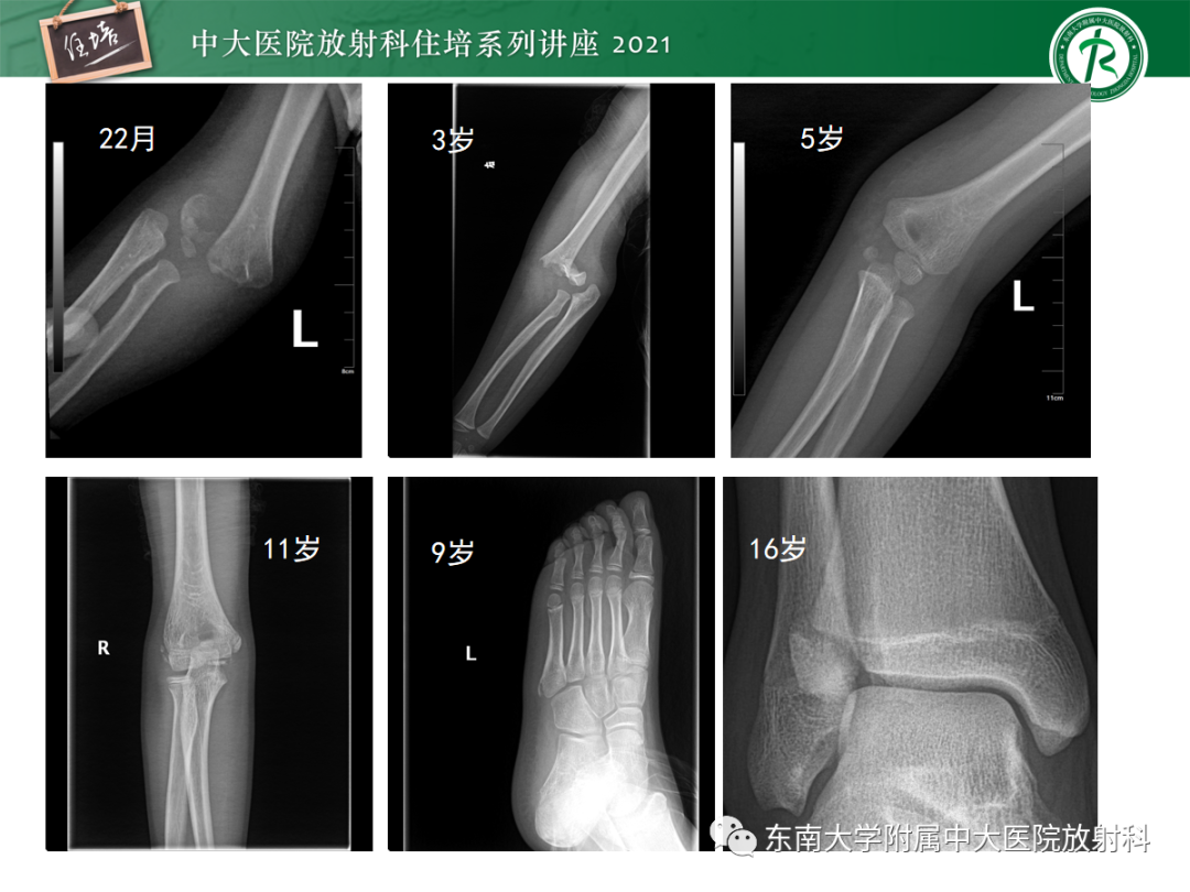 影像PPT - 【PPT】儿童骨关节损伤-2