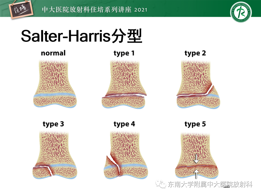 影像PPT - 【PPT】儿童骨关节损伤-10