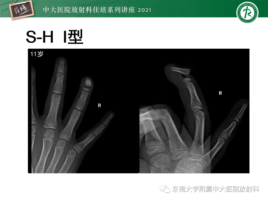 影像PPT - 【PPT】儿童骨关节损伤-11