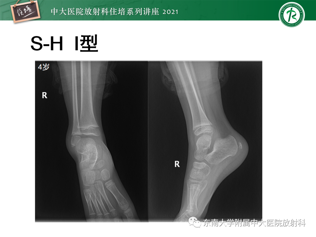 影像PPT - 【PPT】儿童骨关节损伤-12