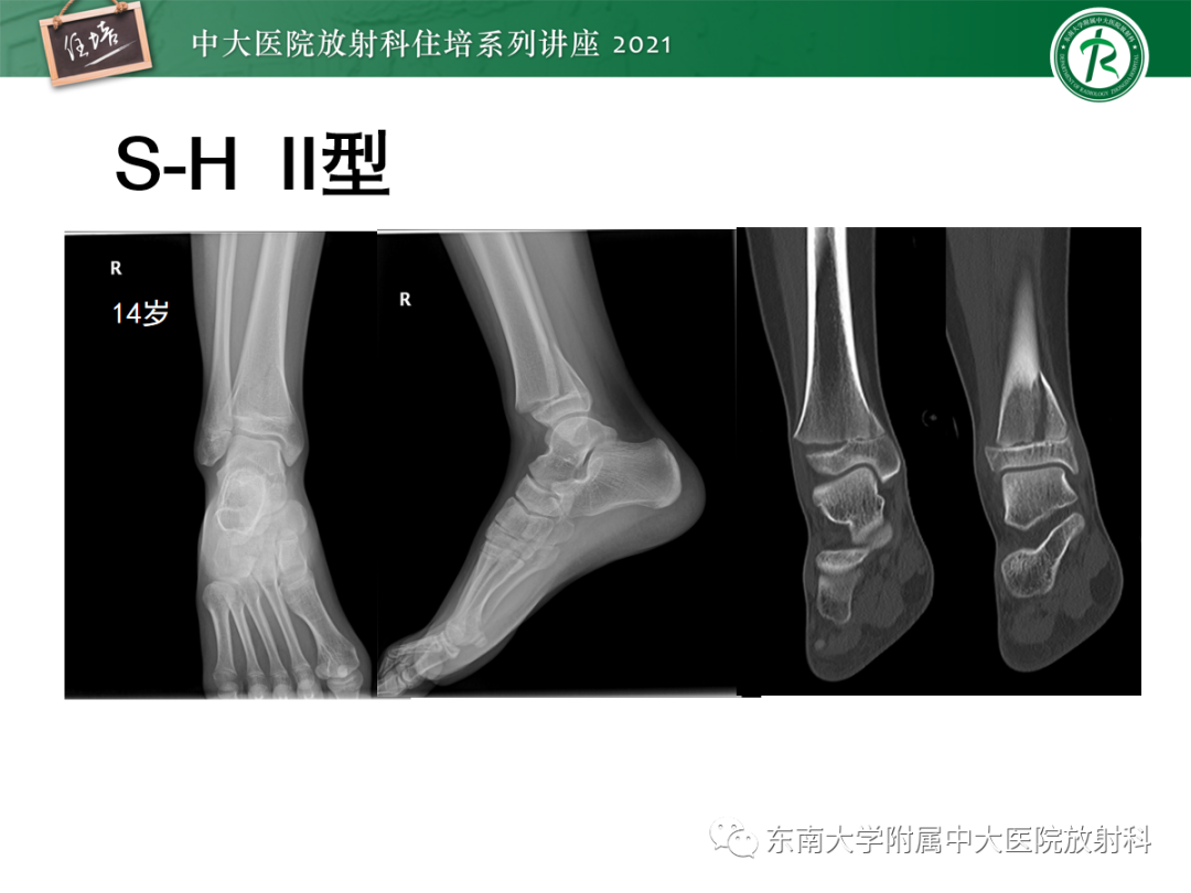 影像PPT - 【PPT】儿童骨关节损伤-13