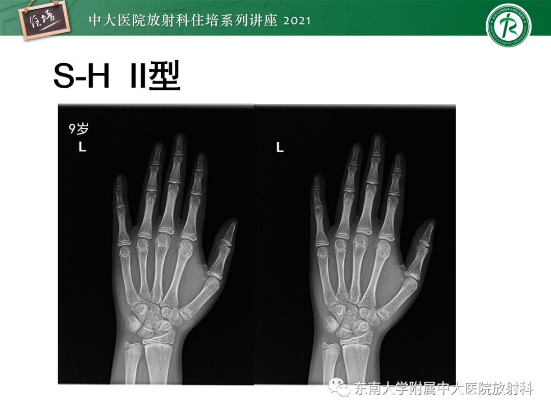 影像PPT - 【PPT】儿童骨关节损伤-14