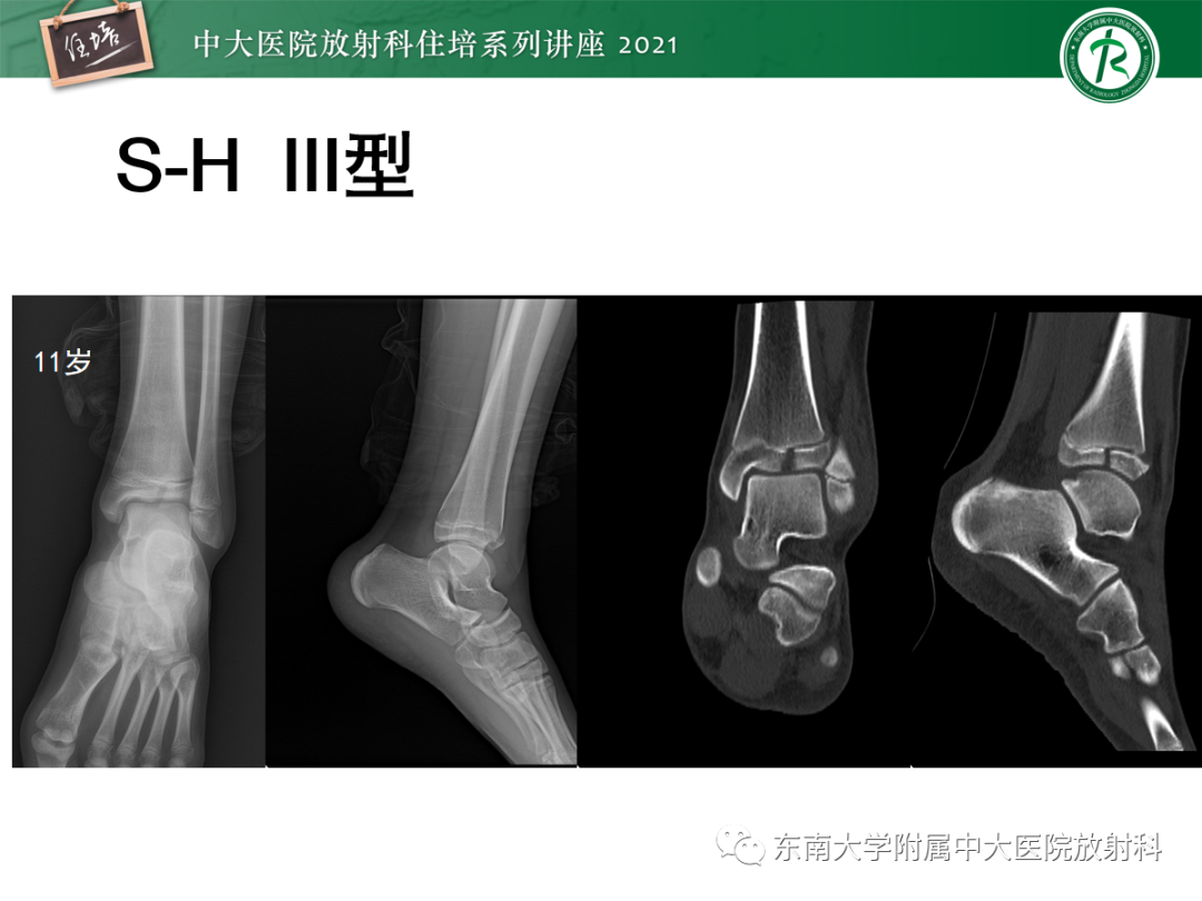 影像PPT - 【PPT】儿童骨关节损伤-16