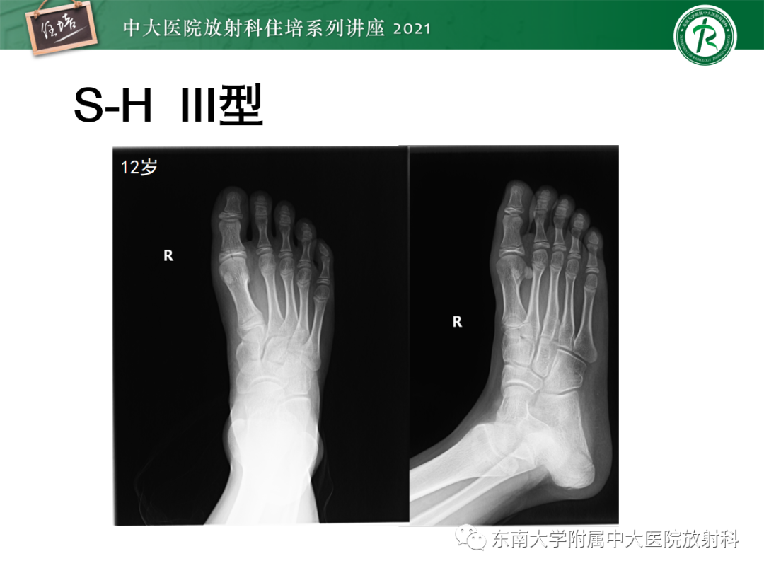影像PPT - 【PPT】儿童骨关节损伤-15
