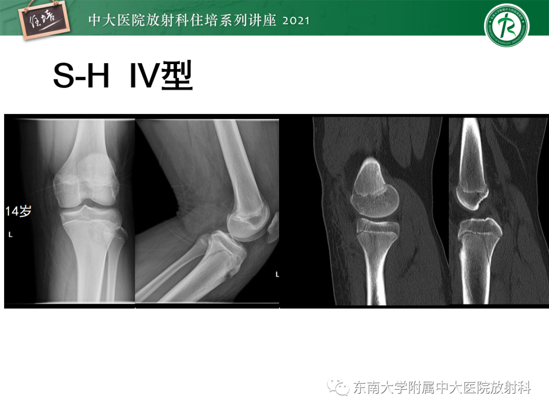 影像PPT - 【PPT】儿童骨关节损伤-17