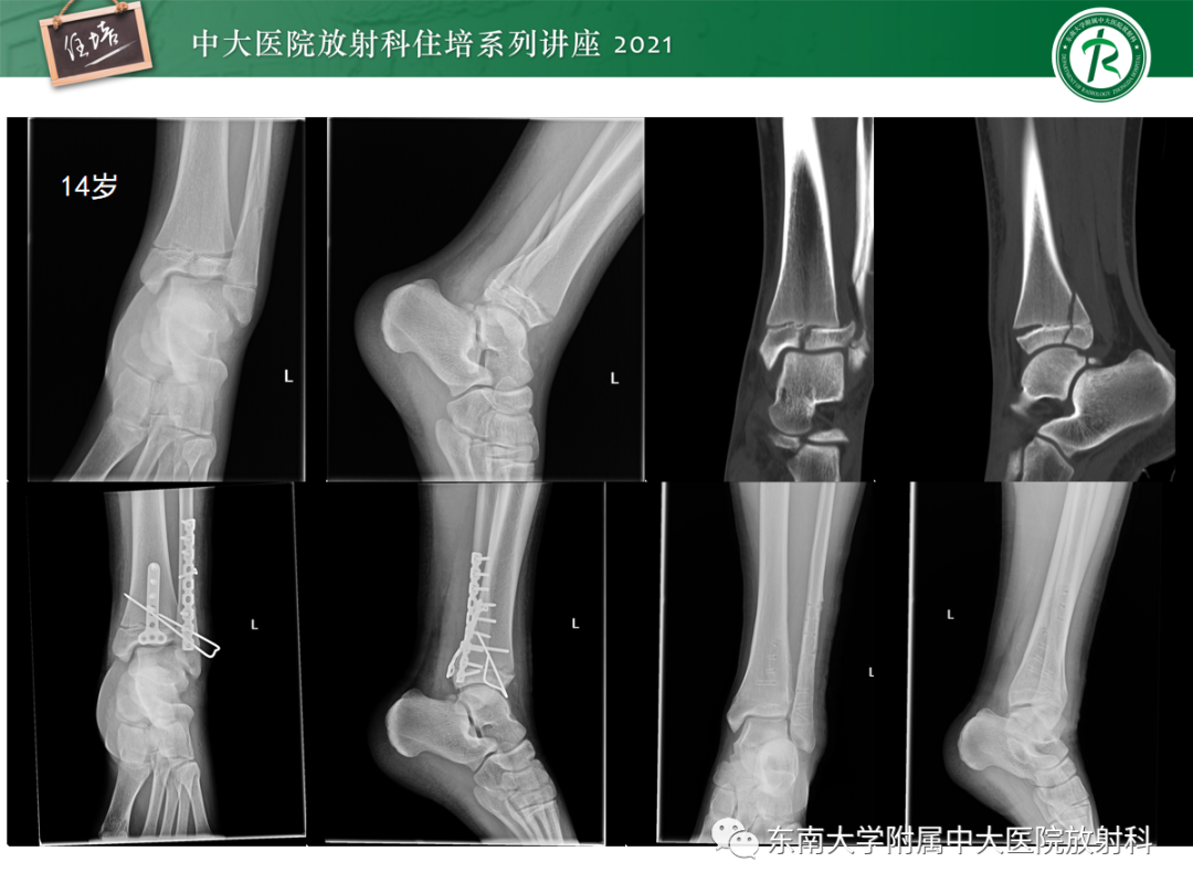 影像PPT - 【PPT】儿童骨关节损伤-18