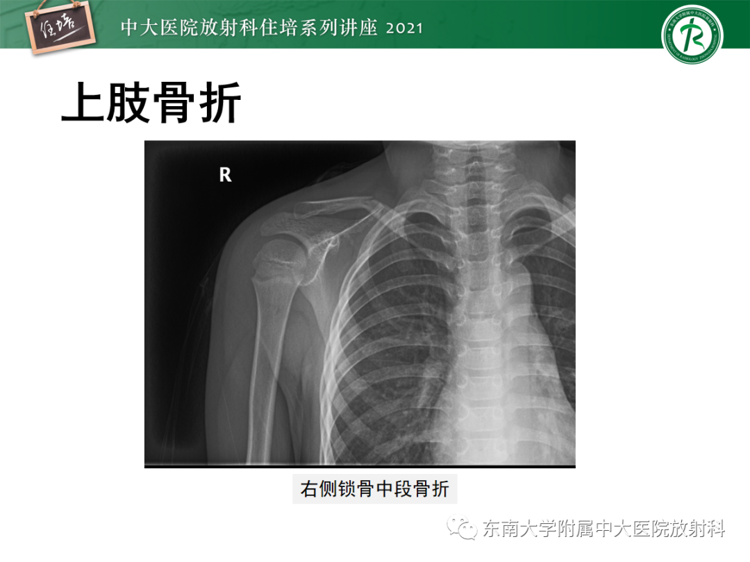 影像PPT - 【PPT】儿童骨关节损伤-20
