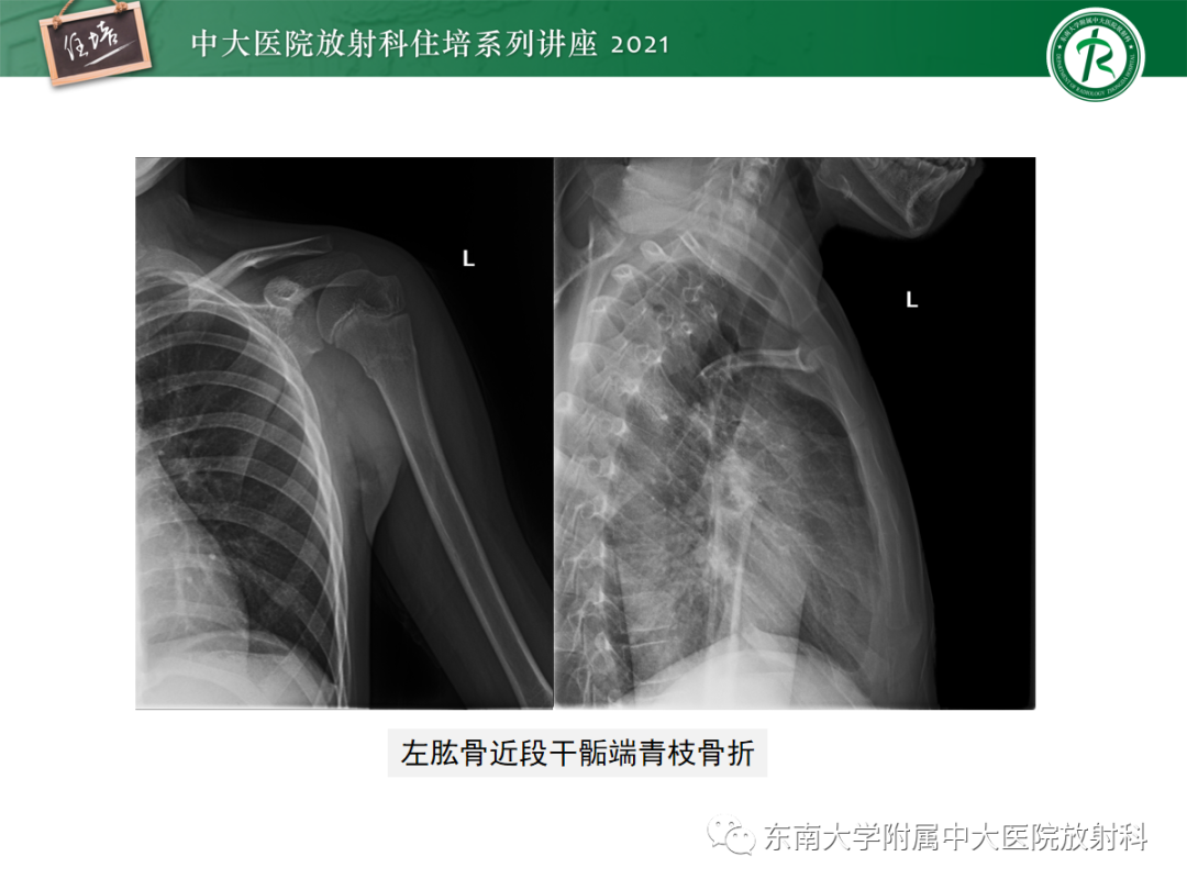 影像PPT - 【PPT】儿童骨关节损伤-21