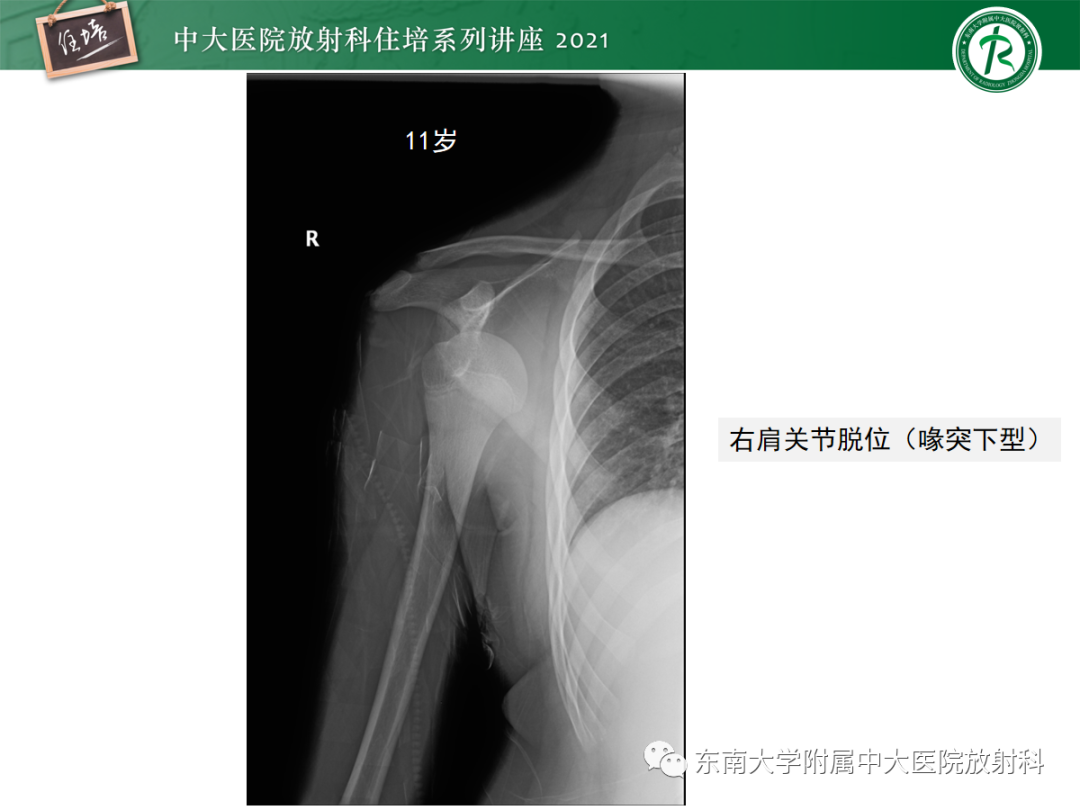 影像PPT - 【PPT】儿童骨关节损伤-22