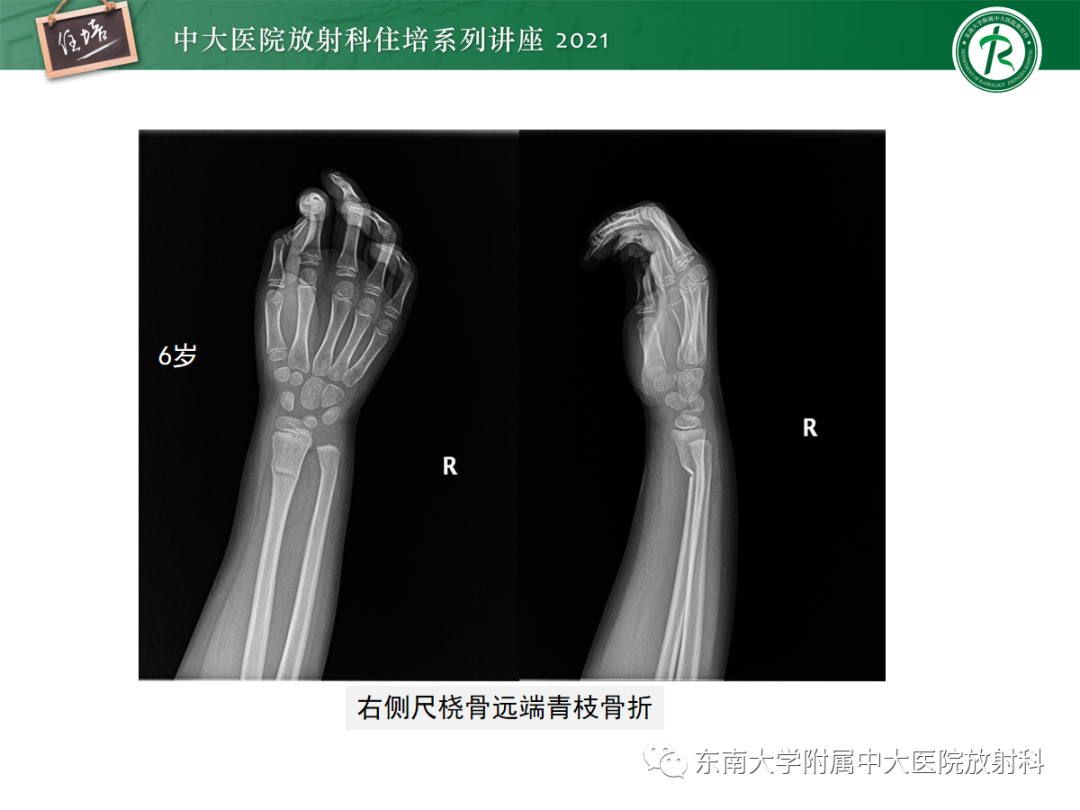 影像PPT - 【PPT】儿童骨关节损伤-23