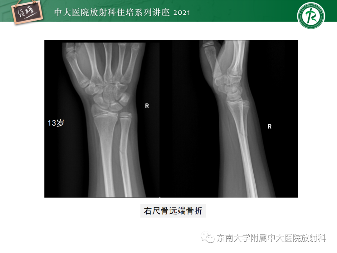 影像PPT - 【PPT】儿童骨关节损伤-24