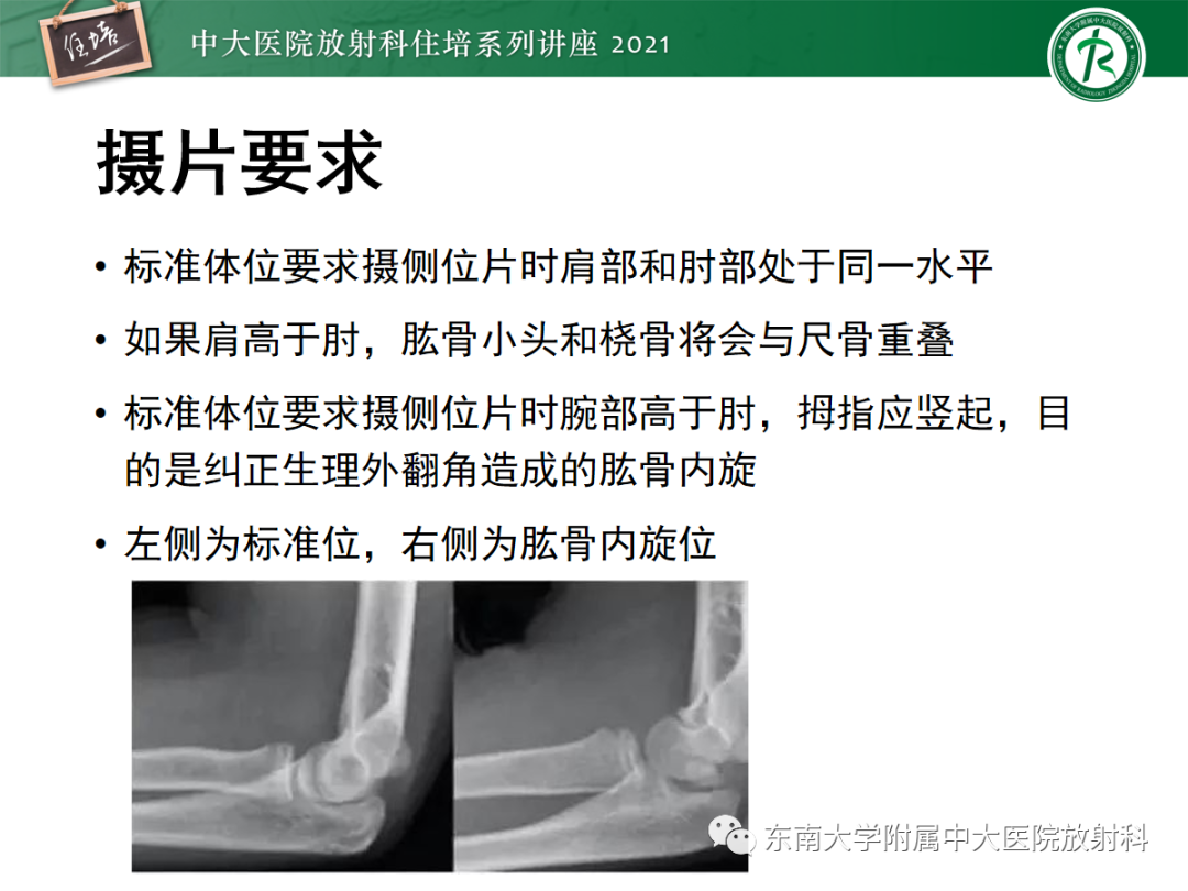 影像PPT - 【PPT】儿童骨关节损伤-26
