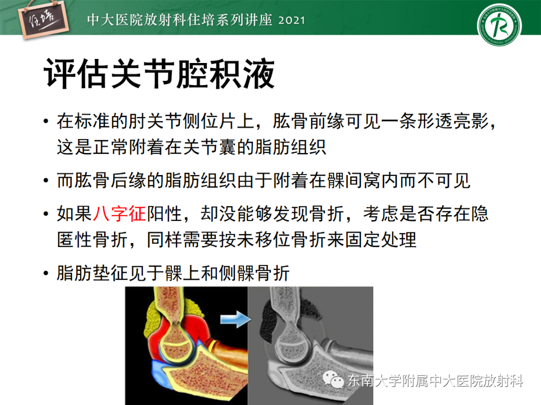 影像PPT - 【PPT】儿童骨关节损伤-29