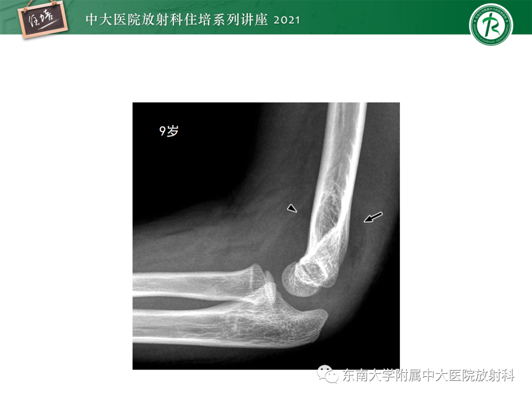 影像PPT - 【PPT】儿童骨关节损伤-30