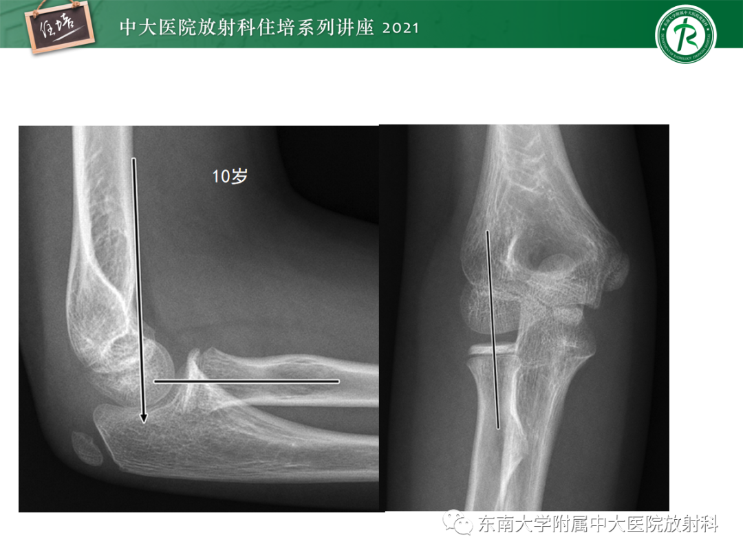影像PPT - 【PPT】儿童骨关节损伤-32