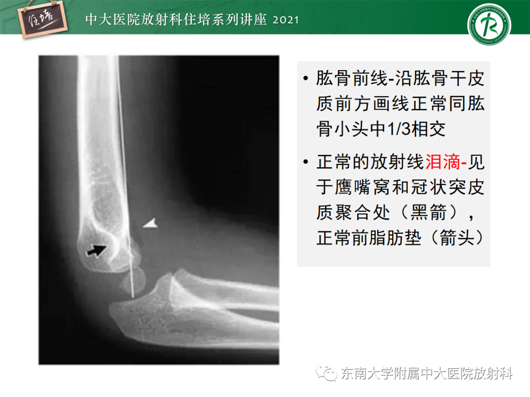 影像PPT - 【PPT】儿童骨关节损伤-33