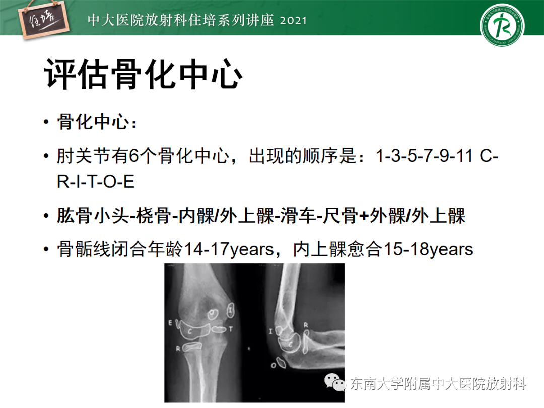 影像PPT - 【PPT】儿童骨关节损伤-34