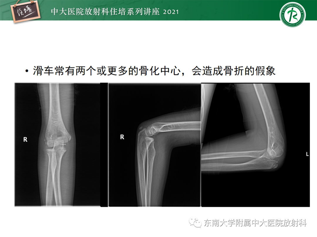 影像PPT - 【PPT】儿童骨关节损伤-35