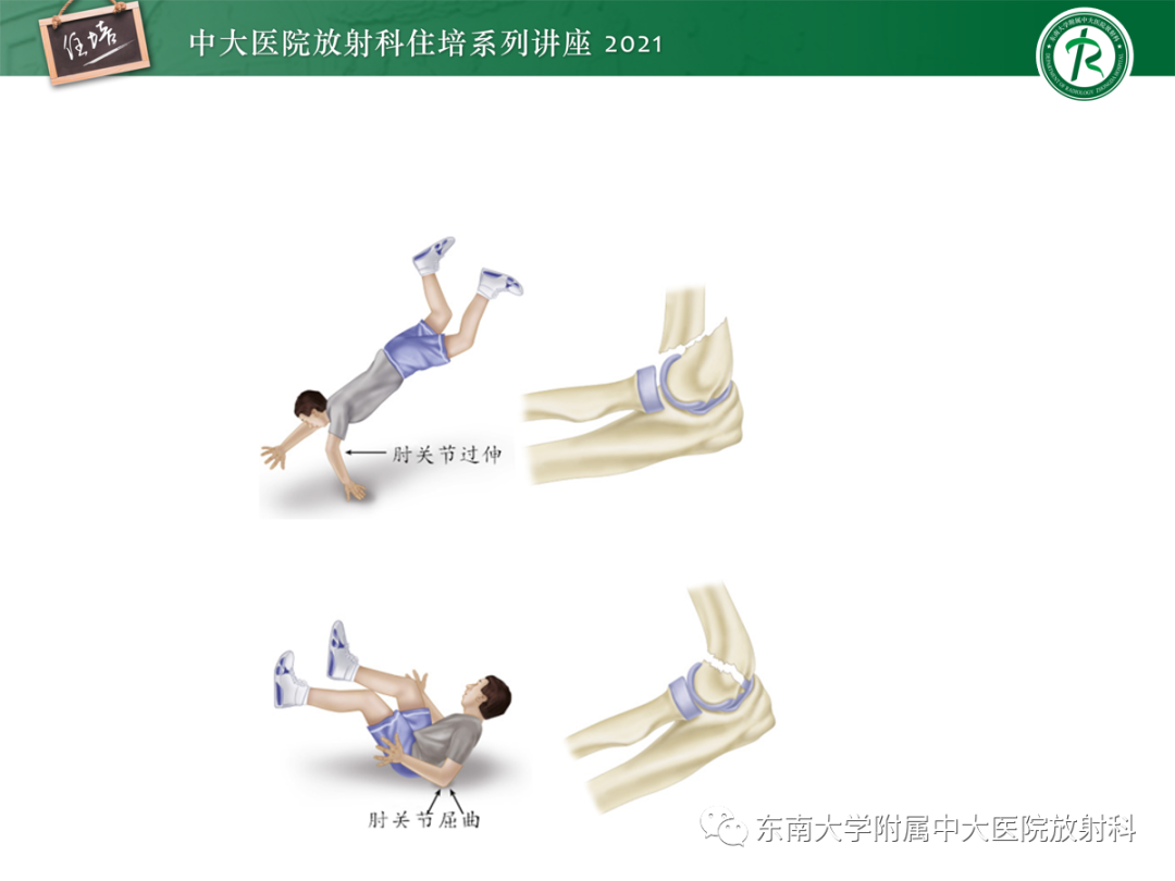 影像PPT - 【PPT】儿童骨关节损伤-38
