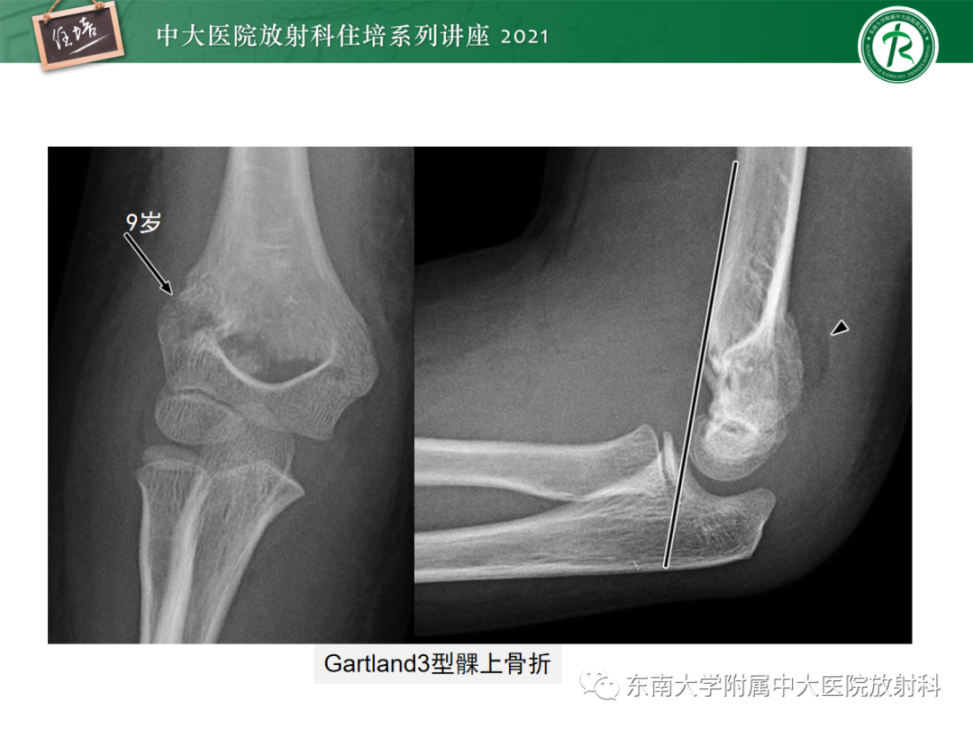 影像PPT - 【PPT】儿童骨关节损伤-39