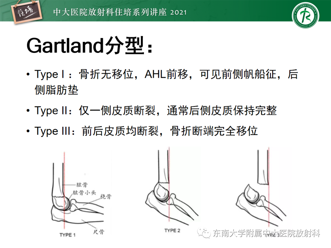 影像PPT - 【PPT】儿童骨关节损伤-40