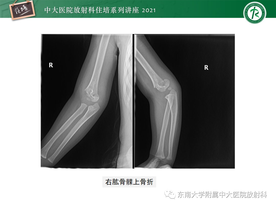 影像PPT - 【PPT】儿童骨关节损伤-41